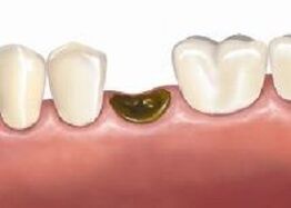 complicações após extração dentária