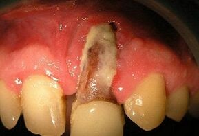 osteomielite após extração dentária