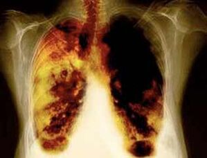 lesões pulmonares ao usar nicotina